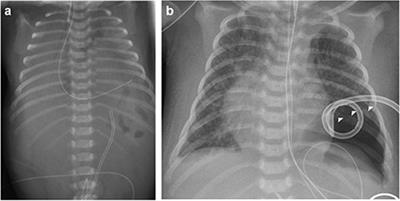 De Novo Duplication of 11p15 Associated With Congenital Diaphragmatic Hernia